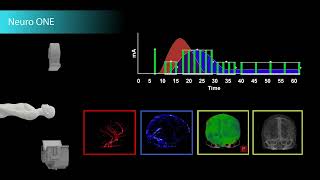 Complete Brain Perfusion Imaging in Just One Minute [upl. by Ennaesor]