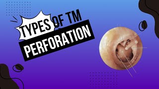 Just in 2 mins  Tympanic membrane perforation types [upl. by Aelsel123]