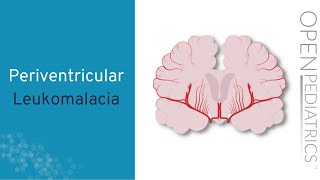 quotPeriventricular Leukomalaciaquot by Anne Hansen MD MPH for OPENPediatrics [upl. by Earized]