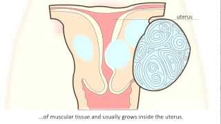 Fibroid  What is a fibroid and how can it be treated [upl. by Orvah]