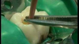 Endodontie mécanisée le système PROTAPER® principes et guide dutilisation [upl. by Grieve]