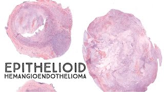 Epithelioid hemangioendothelioma EHE Australasian Dermpath 2022  Case 9 pathology dermatology [upl. by Ahsoyem]