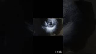 echocardiography echocardiographer echo video case 12 [upl. by Cinda]