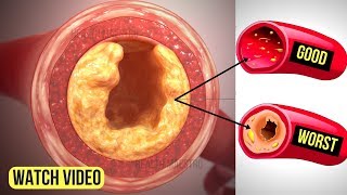 Just 3 Ingredients Will Unclog Your Arteries Without Medication and Reduce Cholesterol Fast [upl. by Golding]