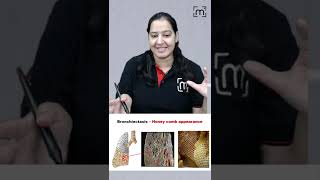 Honeycomb Appearance  Bronchiectasis  MedLive  Dr Priyanka Sachdev [upl. by Cela]