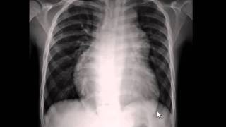 Chest xray  pulmonary arterial hypertension [upl. by Kcirdet]