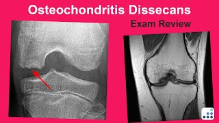 Osteochondritis Dissecans Exam Review  Mark Pagnano MD [upl. by Noyerb]