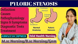 Pyloric Stenosis in Pediatric Nursing  Projectile Vomiting  Causes  Pathophysiology  Treatment [upl. by Auqemahs]