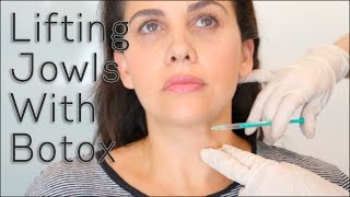 Lifting Jowls With Botox  BLUSH Beverly Hills [upl. by Orella]