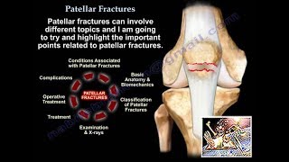 Patellar Fractures  Everything You Need To Know  Dr Nabil Ebraheim [upl. by Hayimas]