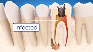 Root Canal Treatment Step by Step [upl. by Tubb975]