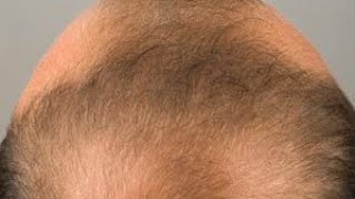 Hair falling treatment د ویختو غرضیدو علاجhairgrowth hearfall [upl. by Adleremse]