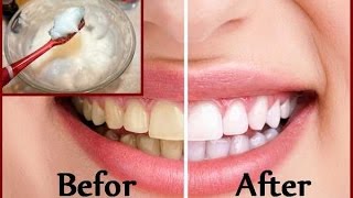 DIY Teeth Whitening at Home in 2 minutes [upl. by Amice608]