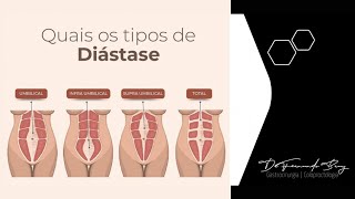 Diástase Abdominal Como funciona a Correção de Diástase por Cirurgia Robótica [upl. by Hecht]