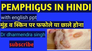 Pemphigus in hindi  pemphigus symptoms  pemphigus causes in hindi  pemphigus lecturer in hindi [upl. by Yelnek]