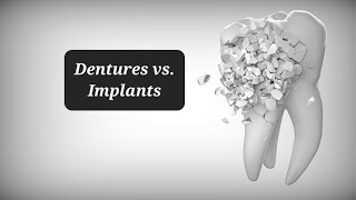 Dentures vs Dental Implants why I chose Dentures [upl. by Tenn]