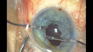 Iridoplasty for traumatic mydriasis with new iris forceps from Geuder [upl. by Annat]