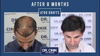 Dr Cinik Hair Transplant Clinic  4700 GRAFTS  2 Sessions  Hair Transplant  Dr Emrah Cinik [upl. by Eadrahc]