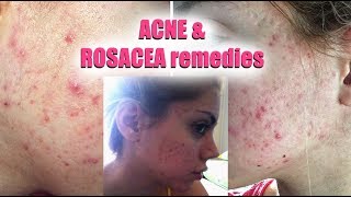 HOW TO GET RID OF ACNE AND ROSACEA  Pershii [upl. by Walcoff943]