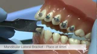 American Orthodontics Alexander LTS Brackets  Bracket Placement Video [upl. by Yardley]