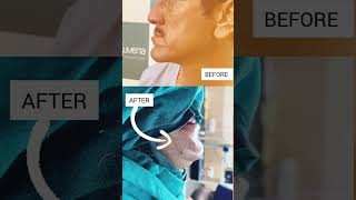 Chin Correction Surgery Before and After  Rejuvena Cosmo Care Jaipur by Dr Deepesh Goyal [upl. by Assilla]