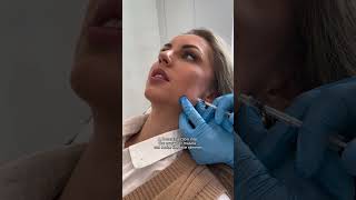 Masseter botox against grinding and clenching [upl. by Nairda]