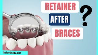 The Best Retainer After Braces [upl. by Moskow]