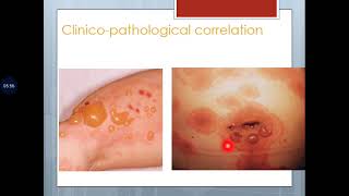 Basic Dermatopathology 14 Algorithm for inflammatory dermatopathology [upl. by Elockin]