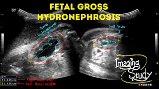 Fetal Unilateral Hydronephrosis  Ultrasound  Anomaly  Case 44 [upl. by Aramoix]