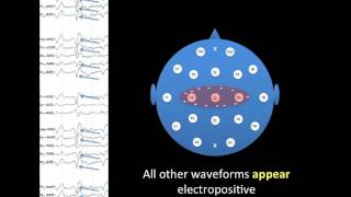 EEG Montages [upl. by Aniarrol]