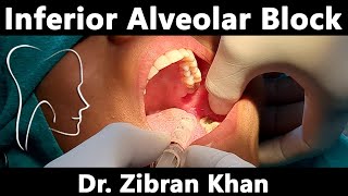 Inferior Alveolar amp Lingual Nerve Block  Clinical Demonstration [upl. by Mcspadden]