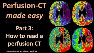 Perfusion CT made easy  part 3  How to read perfusion CT [upl. by Ainesej]