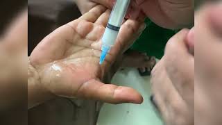 Trigger Finger Treatment Corticosteroid Injection [upl. by Christi]