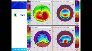 Quick guide to reading corneal tomography Part 6 [upl. by Ylrad]