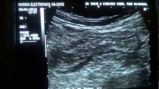 DIVERTICULITIS sigmoidocolonic [upl. by Debora]