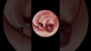 How Gastrointestinal Endoscopy Worksएंडोस्कोपी कैसे होती हैshorts [upl. by Anigal455]