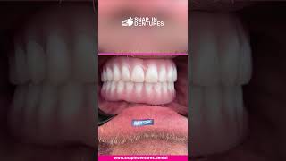 Johns Snap in Denture Before and After [upl. by Ssitnerp]