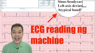 Machineinterpreted ECG Ok na ba [upl. by Stephenie]