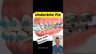 Elastics to Fix Your Underbite Heres How dentallan dentist shorts [upl. by Iclehc]