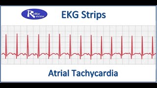 NCLEX EKG STRIPS Atrial Tachycardia [upl. by Tegdig]