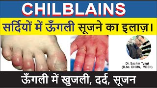 Chilblains सर्दियों मैं उँगलियाँ लाल  सूजने का इलाज  Swollen hands and fingers in Winter [upl. by Singband]