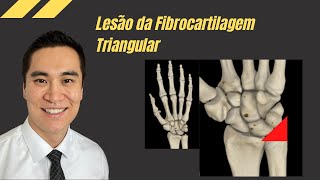 Lesão da Fibrocartilagem Triangular [upl. by Lebama]