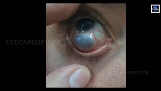 Guess the condition eyecareoptom conjunctiva eye eyeproblem [upl. by Jaf161]