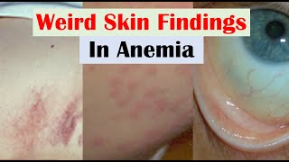 Anemia and Skin Findings along with Nail Changes and Mouth Sores [upl. by Fidelia]