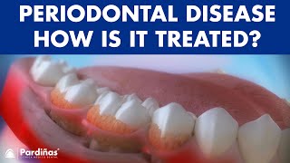 Periodontitis and its influence on health  How is periodontal disease treated © [upl. by Zil]