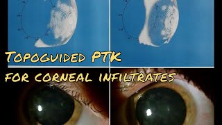 Corneal LASER Surgery Transepi Topographyguided PTK for treatment of adenovirus nummular keratitis [upl. by Vasily129]