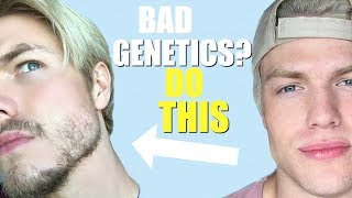 How to Grow a BEARD Even With BAD GENETICS Minoxidil Update [upl. by Aleekat]