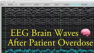 EEG Brain Waves After an Overdose [upl. by Nirre]