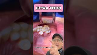 Should You Remove Your Extra Tooth Dentist EXPLAINS  View Mobile Dental shorts [upl. by Sillad412]