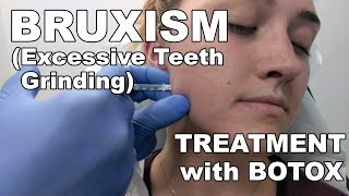 Teeth Grinding Bruxism Treatment with Botox  Dr Paul Ruff  West End Plastic Surgery [upl. by Esidarap95]